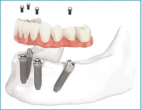 all on 4 dental implants Toronto