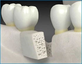 bone grafting Toronto