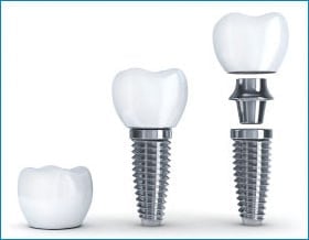 dental implants Toronto