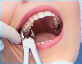 Dental Tooth Extractions in Toronto, Ontario