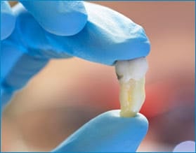 wisdom teeth removal Toronto