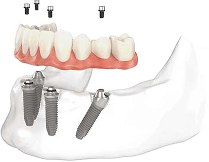 All On 4 Dental Implants North York