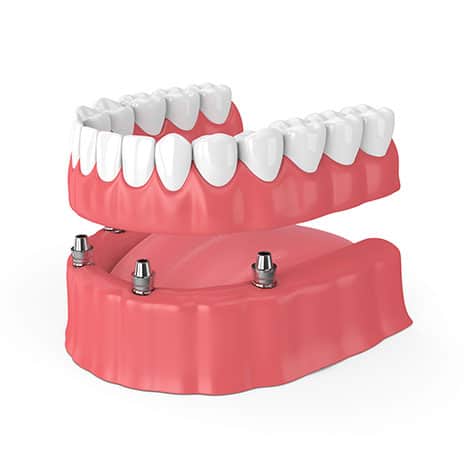 dental implants in north york