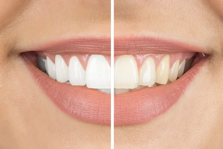 Teeth Whitening in and near North York, ON