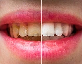 cosmetic-dentistry-complete-smile-makeover