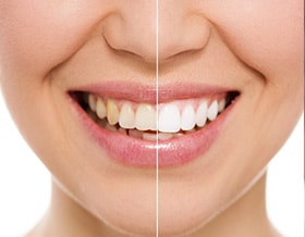 cosmetic-dentistry-teeth-whitening