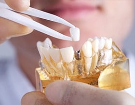 north-york-dental-implants