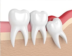 oral-surgeon-wisdon-tooth-removal