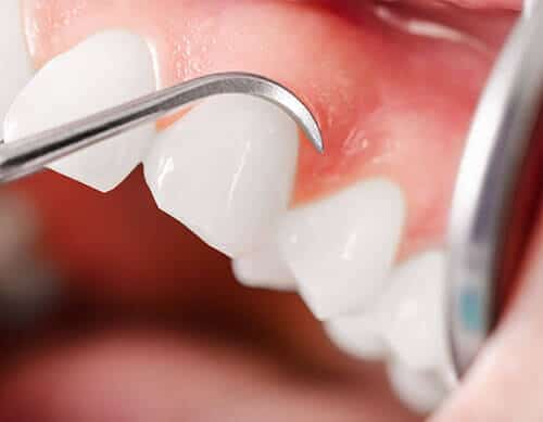 Prevent gum disease north york