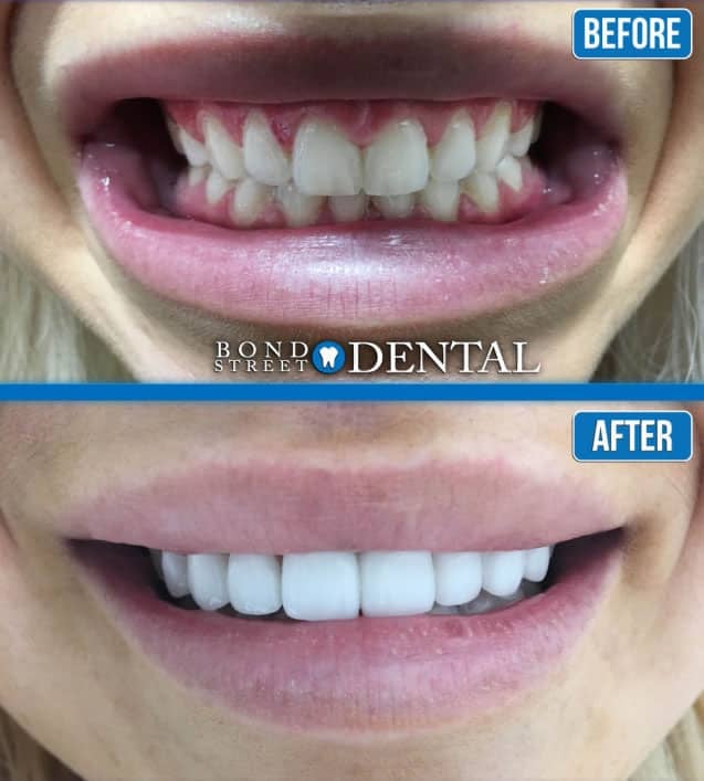 teeth whitening north york