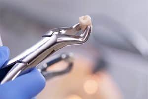 Wisdom Tooth Removal North York