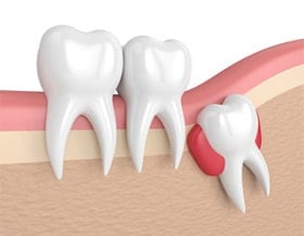 wisdom tooth extraction toronto