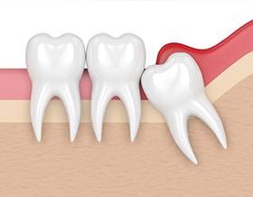 wisdom-tooth-removal-north-york