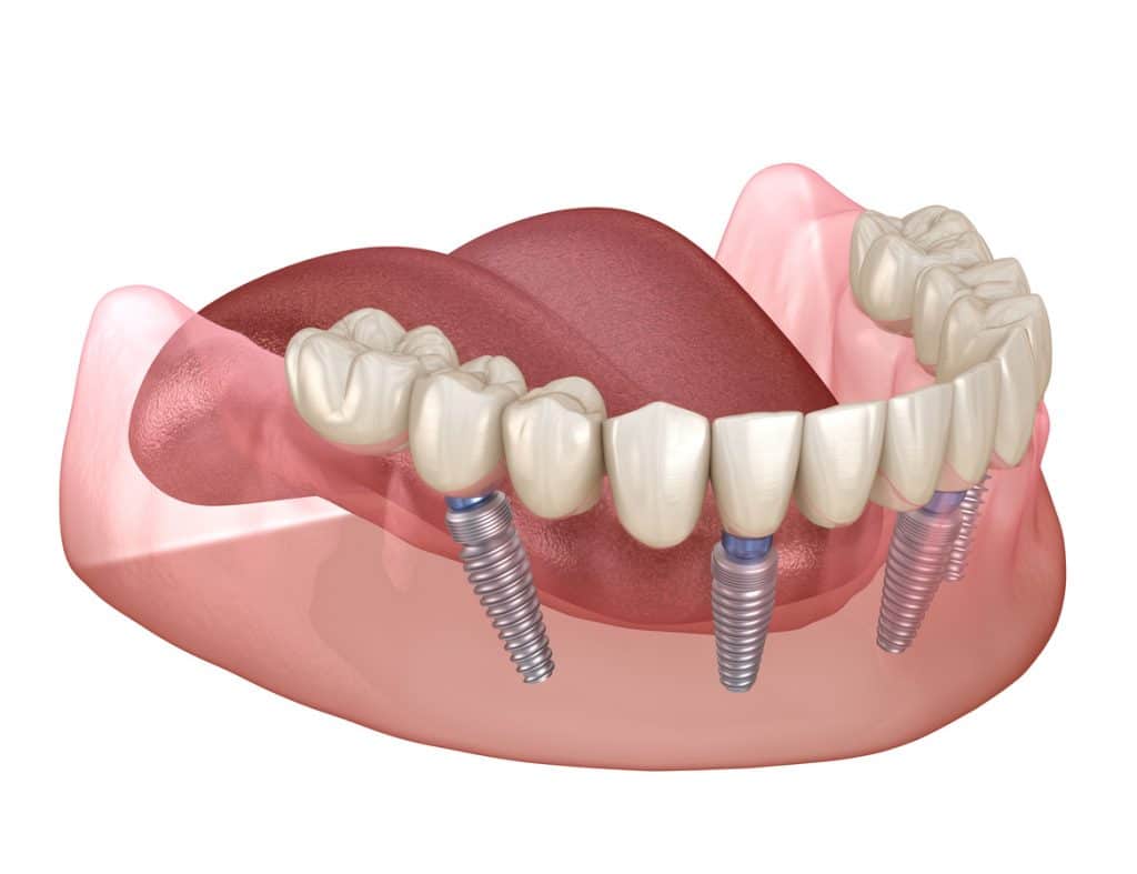 All-On-Four dental implants