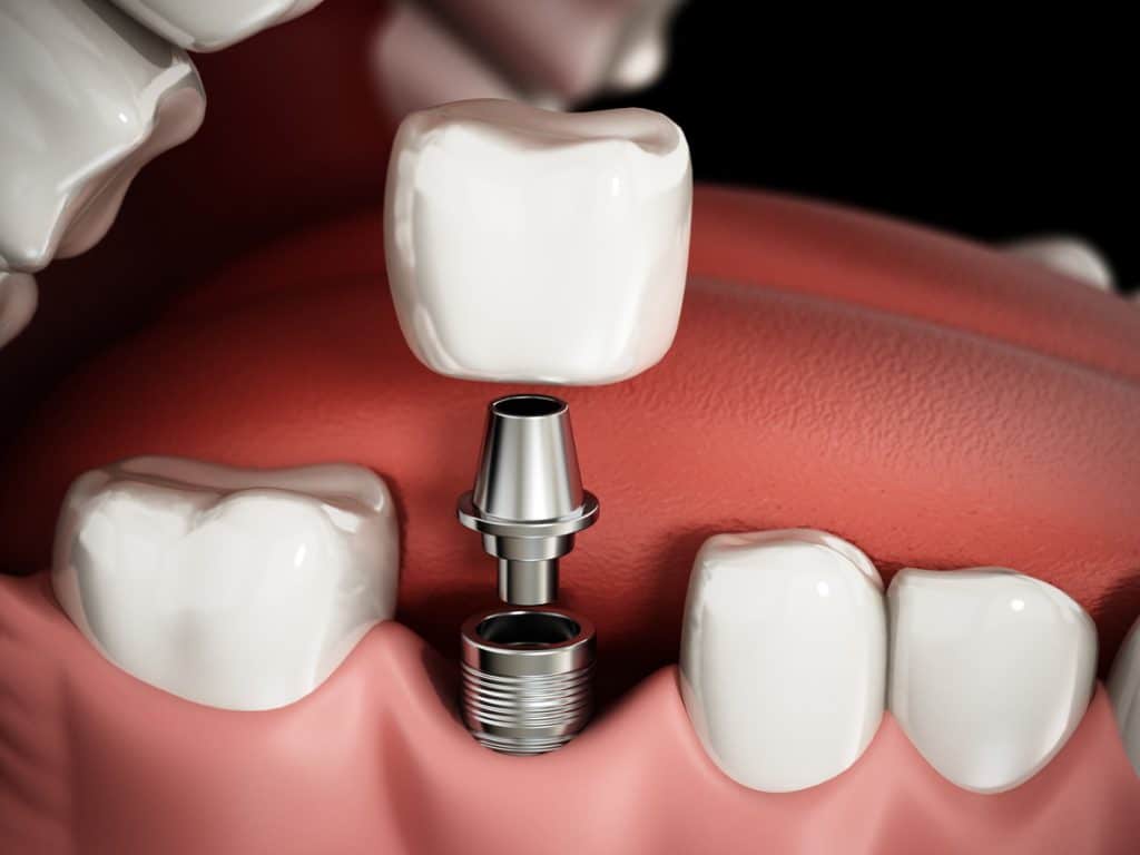 dental implants