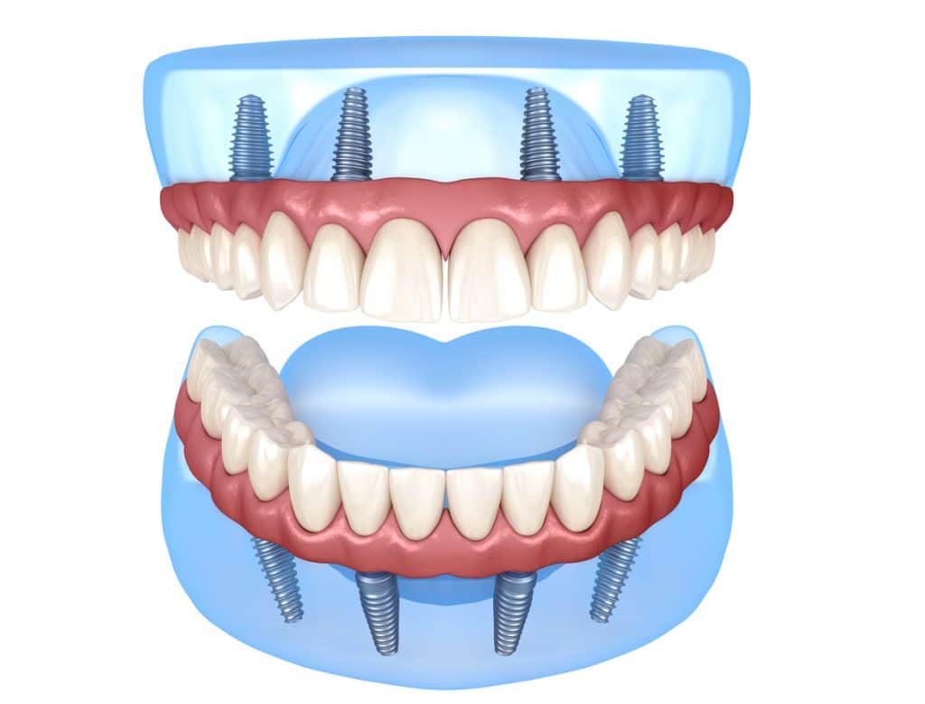 dental implants have been attached to your jawbone