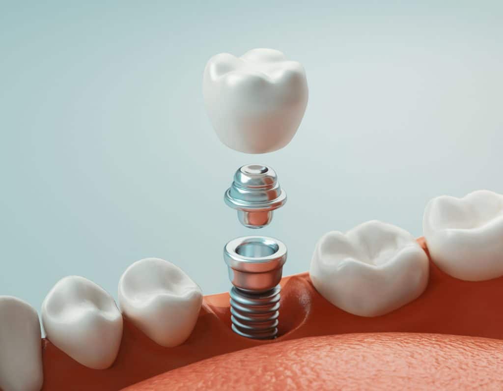 dental implant and a prosthesis