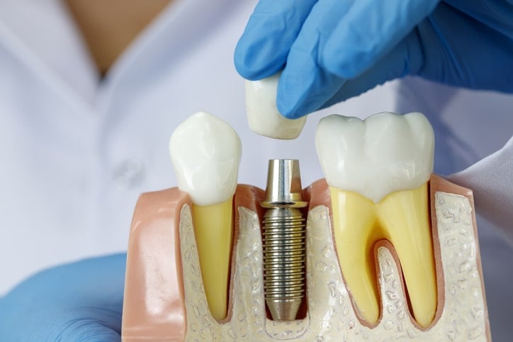 dental implant cross section