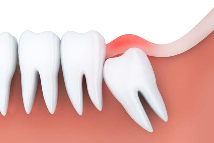 What happens if you don't remove impacted wisdom teeth