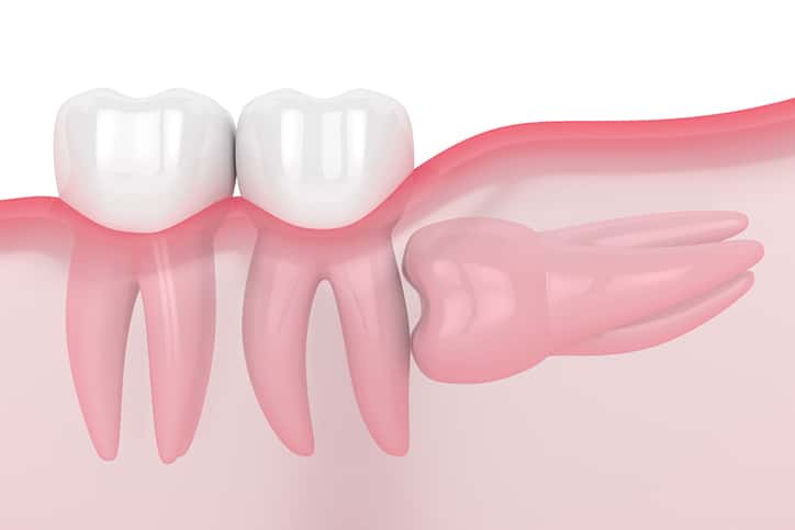 When is Wisdom Teeth Extraction Necessary