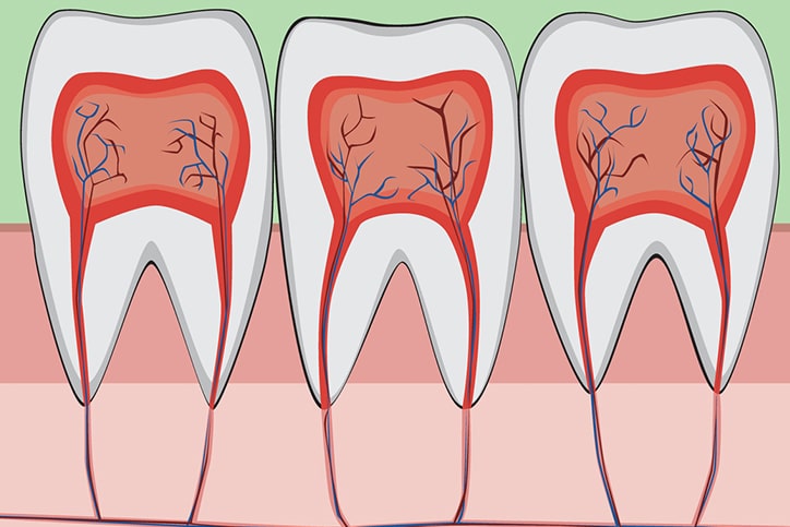 cutaway tooth showing nerves on gum