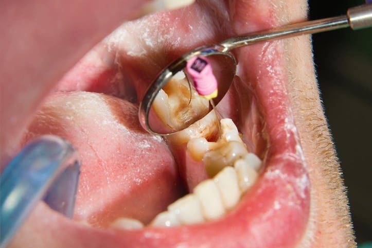 Root canal treatment procedure