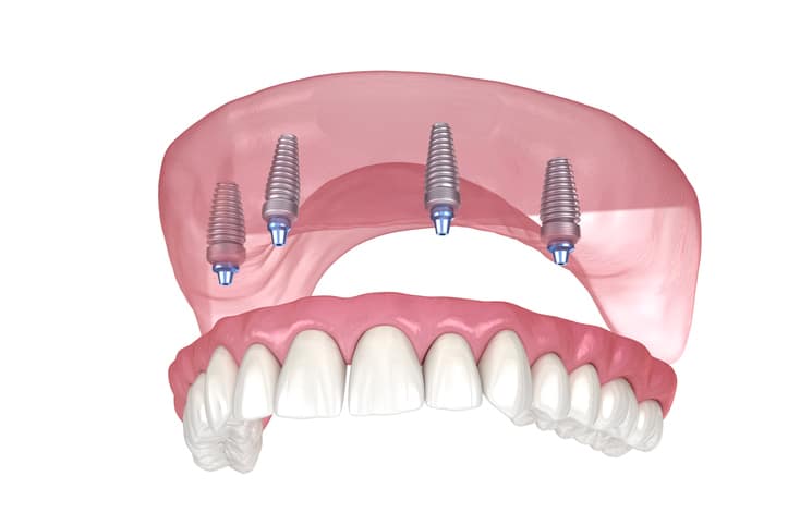 all on 4 dental implants