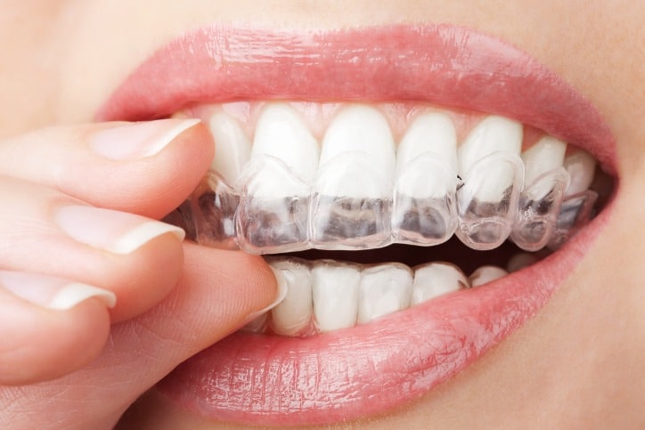 How much invisalign cost